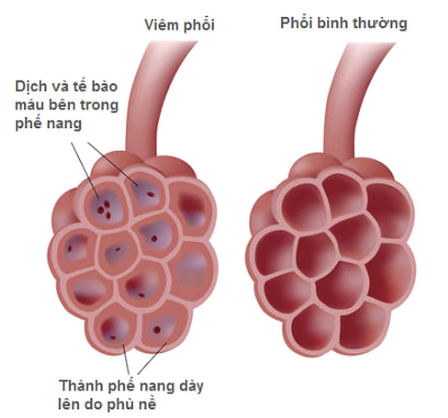 bệnh viêm phổi